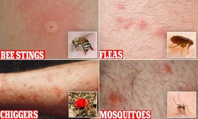 types of bug bites on skin
