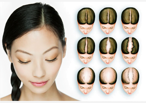 cause of hair loss in women